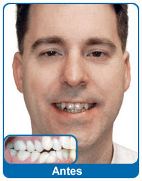 Antes do aparelho dentário - paciente 3