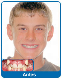 Antes do aparelho dentário - paciente 1