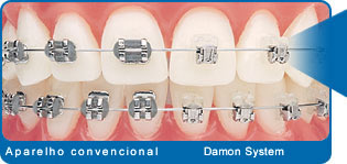 aparelho-dentario-Damon-System