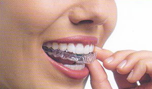 Aparelhos Dentários Transparentes