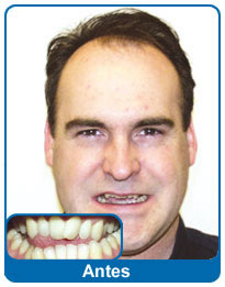 Antes do aparelho dentário - paciente 5