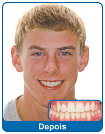 Depois do aparelho dentário - paciente 1