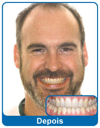 Depois do aparelho dentário - paciente 5