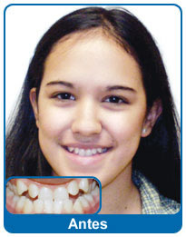 Antes do aparelho dentário - paciente 2