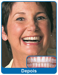 Depois do aparelho dentário - paciente 4