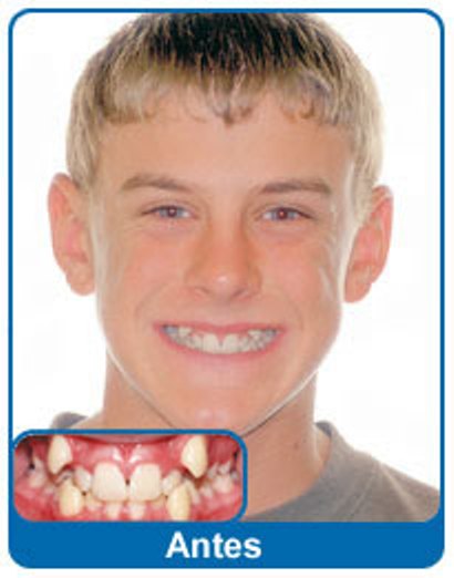 Featured image of post Dente Encavalado Com Aparelho Antes E Depois Hoje existem alternativas para quem n o quer chamar a