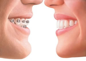 antes e depois do aparelho dentario